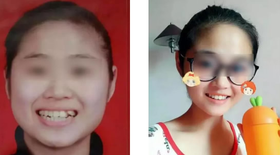 天津美奧口腔戴隱形牙套矯正牙齒560天后 和齙牙凸嘴拜拜了