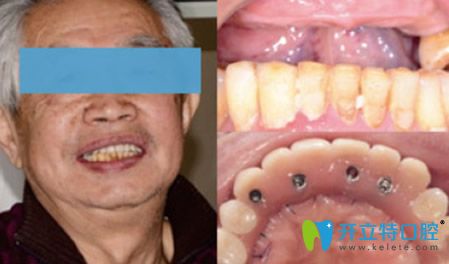 拜博口腔張玉林醫(yī)生種植牙效果案例