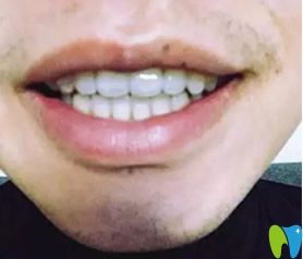 長沙牙祖口腔隱形矯正牙齒一年后效果