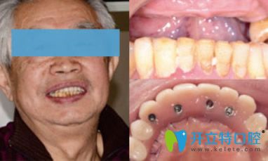 <!--<i data=20240703-sp></i>-->口腔半口牙缺失種植效果