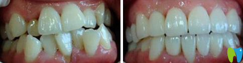 泰州北極星口腔牙齒矯正前后對(duì)比圖