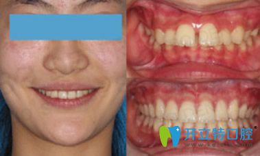 拜博口腔隱形矯正牙齒案例