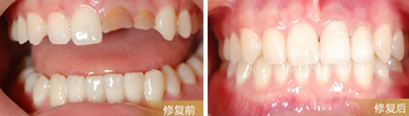 朋友問天津陽光樹口腔是公立還是私立？烤瓷牙做的怎么樣