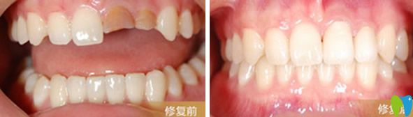 陽光樹口腔烤瓷牙修復前后效果對比