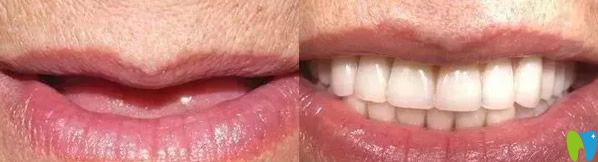 金鉑利口腔韓相國院長種植牙案例