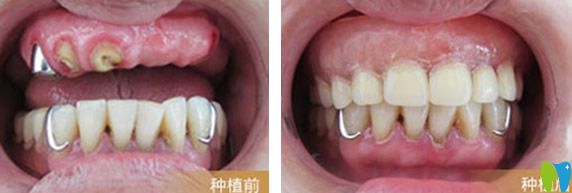天津陽光樹口腔張蓉種植牙效果案例