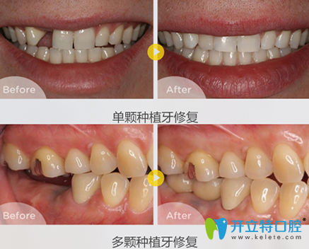泰州北極星口腔姬輝種植牙前后效果對比圖