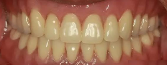 長(zhǎng)沙好大夫口腔種植效果案例 看82歲全口牙缺失變形記