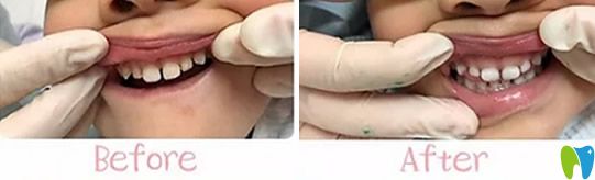 <!--<i data=20240703-sp></i>-->兒童口腔好不好？不妨看看孩子牙齒矯正案例效果