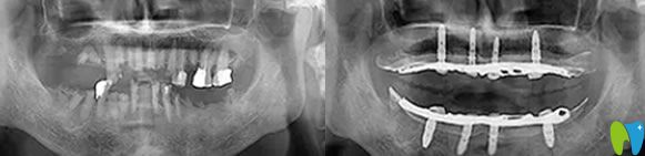 電腦設(shè)計種植后效果圖