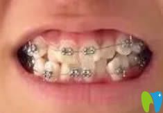 沈陽博得口腔鎮(zhèn)診所金屬托槽牙齒矯正圖