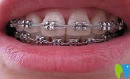 沈陽博得口腔自鎖托槽牙齒正畸圖