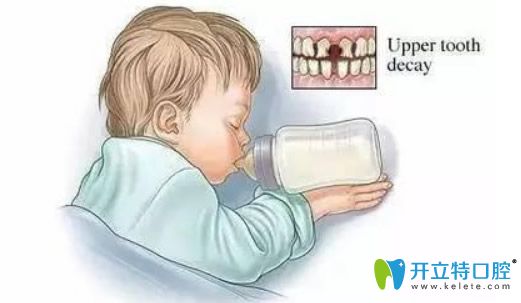 兒童奶瓶齒齲怎么治療?如何避免兒童奶瓶齲?準(zhǔn)媽媽必看寶典