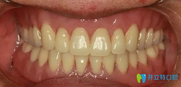 好大夫口腔全口牙種植效果圖