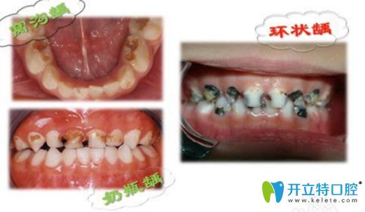 奶瓶齲齒圖片 奶瓶齲齒圖片