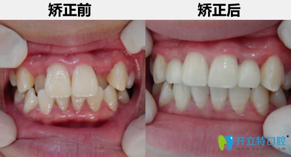 28歲顧客矯正牙齒前后對(duì)比照