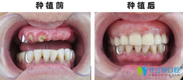 60歲老人半口即刻種植牙前后對(duì)比效果