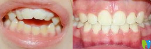 成都維朗口腔尹秋丹的兒童牙齒正畸效果圖