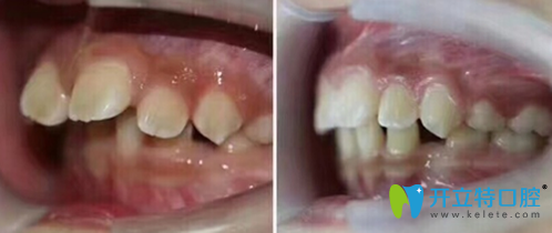 <!--<i data=20240703-sp></i>-->口腔9兒童門牙前突矯正案例