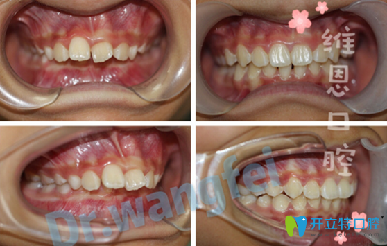 <!--<i data=20240703-sp></i>-->口腔楊占娟兒童早期骨性齙牙矯正案例