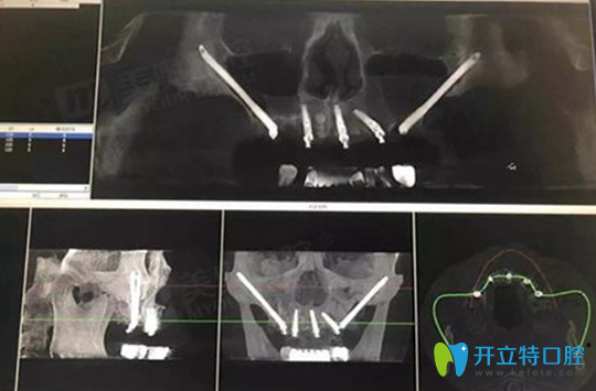 王明會診后給出了種植方案