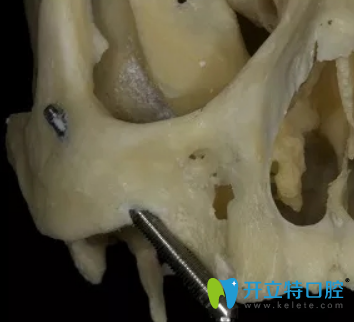 2穿上頜路徑的顴種植體示意圖