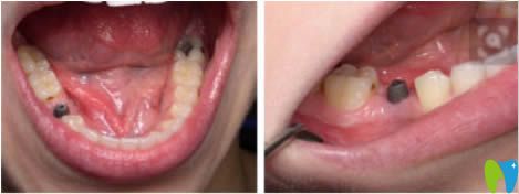 成都維朗口腔做種植牙圖