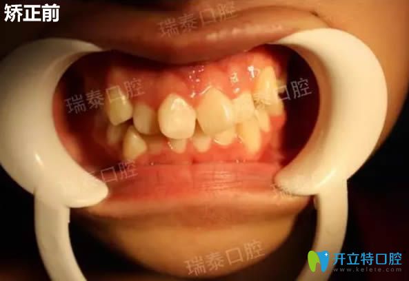 記錄我去西安瑞泰口腔做時(shí)代天使隱形矯正14個(gè)月以來(lái)的感受