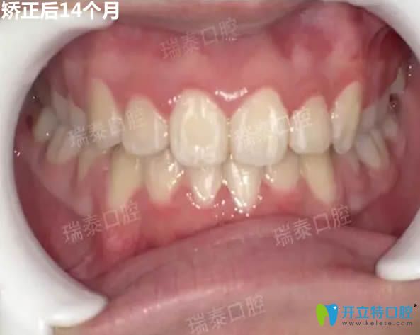 時代天使隱形矯正14個月后效果圖