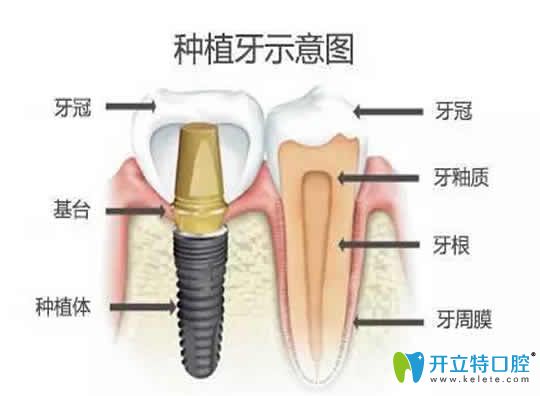 無錫康貝佳口腔醫(yī)生揭露：比種植牙更好的方法及價格