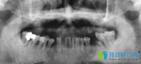 金臺口腔為張叔拍完X光 金臺口腔為張叔拍完X光