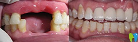 北京維樂口腔門牙缺失怎么辦？70歲趙阿姨在北京維樂口腔做了微創(chuàng)種植牙