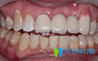 北京維樂(lè)口腔種植牙后照片