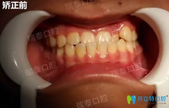 我了解過青島口腔醫(yī)院的價(jià)目表后,去瑞泰口腔做了隱形矯正