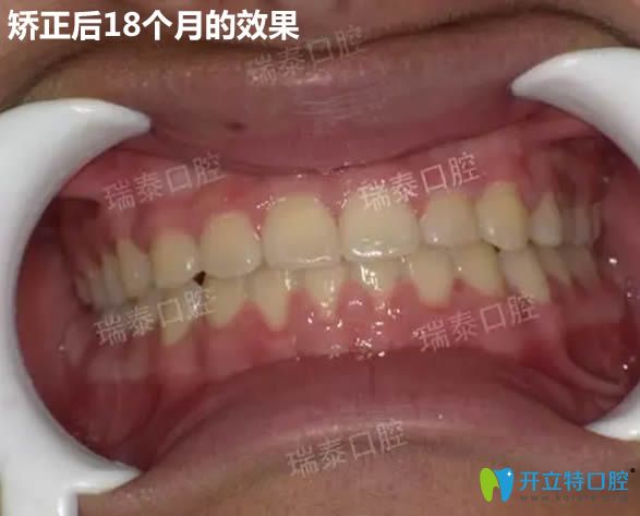 戴隱形牙套18個(gè)月后效果圖