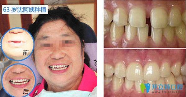 青島拜博口腔種植牙+牙齒矯正效果案例 青島拜博口腔種植牙+牙齒矯正效果案例