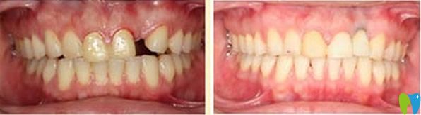 拜博口腔單顆牙缺失種植效果對比 拜博口腔單顆牙缺失種植效果對比