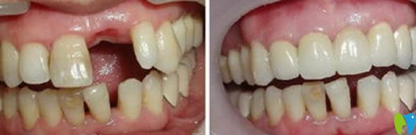 李永平單顆牙即刻種植代表案例