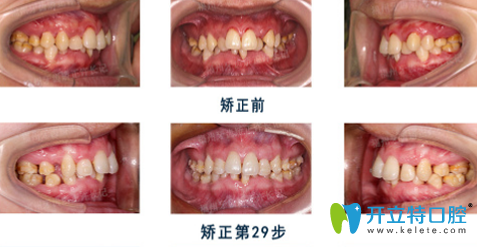 牙醫(yī)許長記怎么樣？看許長記牙齒深覆頜矯正案例