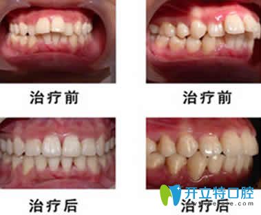<!--<i data=20240703-sp></i>-->齒科<!--<i data=20240703-sp></i>-->牙齒矯正對比圖