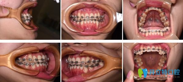 金屬托槽矯正牙齒進(jìn)行中