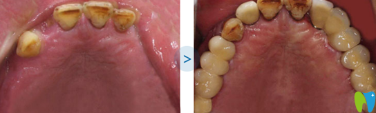 徐震武多顆牙缺失種植案例種植后對(duì)比圖
