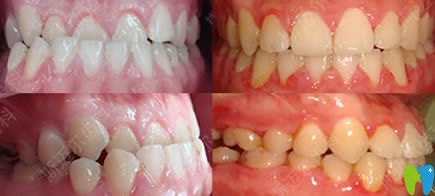 北京斯邁爾齒科骨性錯合牙齒正畸效果圖 北京斯邁爾齒科骨性錯合牙齒正畸效果圖