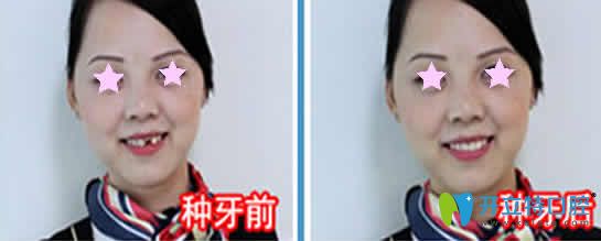 泉州維樂口腔種植牙案例效果圖