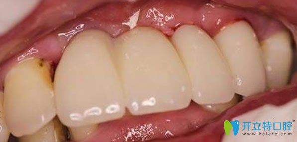 佳士潔口腔多顆牙缺失微創(chuàng)無(wú)痛種植牙術(shù)后效果圖 佳士潔口腔多顆牙缺失微創(chuàng)無(wú)痛種植牙術(shù)后效果圖