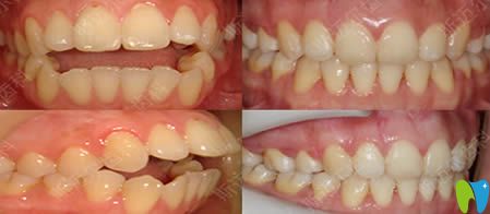 北京斯邁爾開頜/牙列不齊正畸效果圖 北京斯邁爾開頜/牙列不齊正畸效果圖