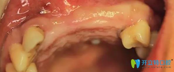 無(wú)錫佳士潔口腔半口牙缺失種植牙前 無(wú)錫佳士潔口腔半口牙缺失種植牙前