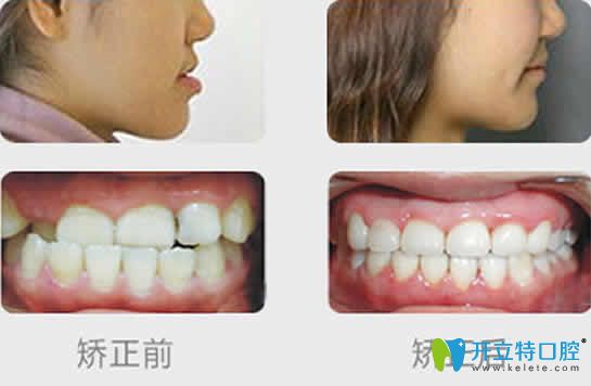 維樂口腔牙齒矯正前后效果對比圖