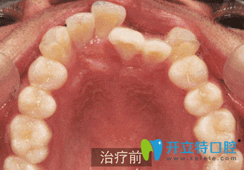 廣州壹加壹口腔矯正牙齒前