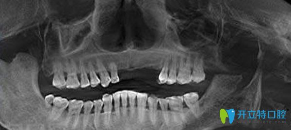 佳士潔口腔種植牙3D檢查圖片 佳士潔口腔種植牙3D檢查圖片